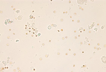 Urine sediment 검사 이미지