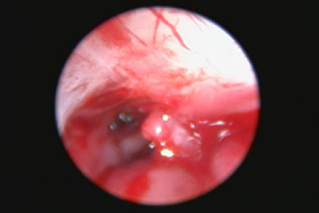 비강 내 Polyp