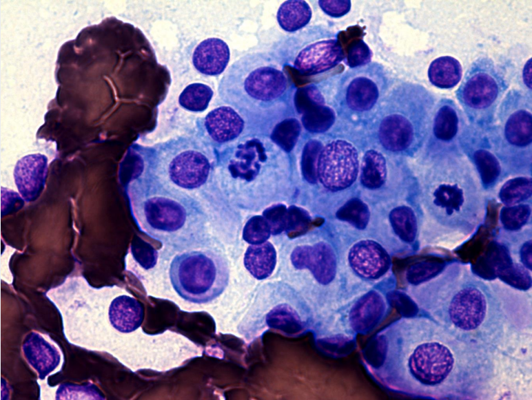 크롬친화세포종(Pheochromocytoma) 종양세포