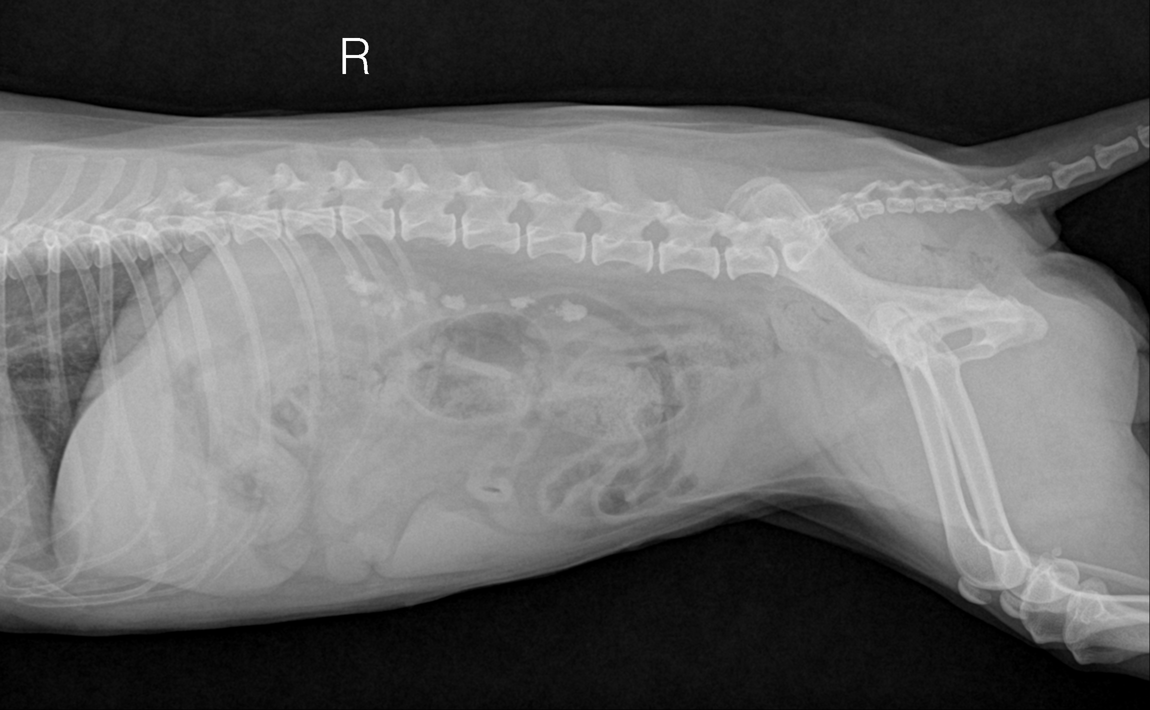 결석 환자의 X-ray 사진